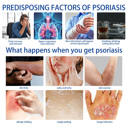 Psoriasis & Sensitive Skin Soothing Cream – Helps Calm Dry, Itchy Skin