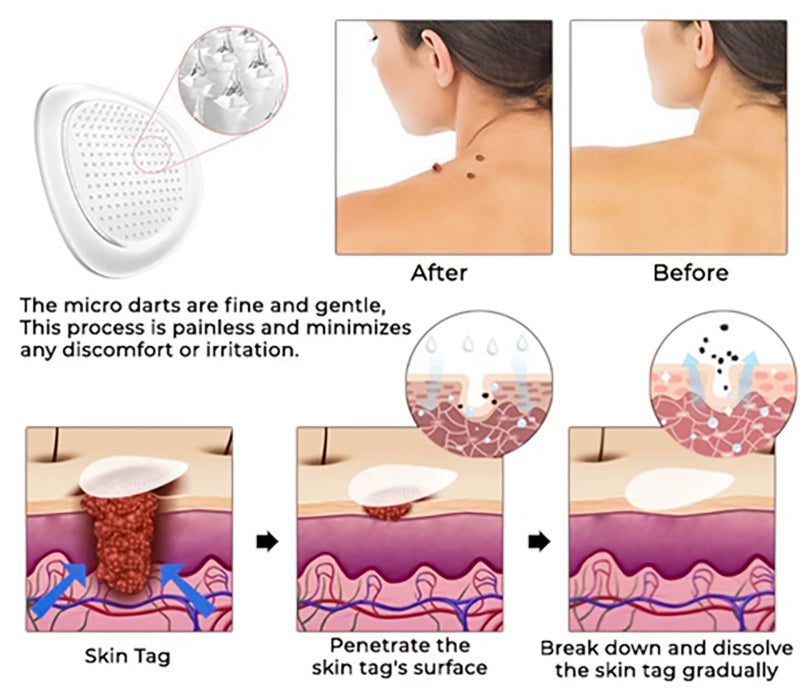 ✨ Alisanda® MicroDarts Skin Tag Patch – Fun Shapes Edition for Gentle Care (offer)