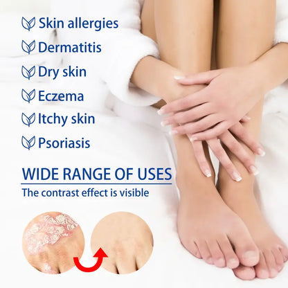 Psoriasis & Sensitive Skin Soothing Cream – Helps Calm Dry, Itchy Skin