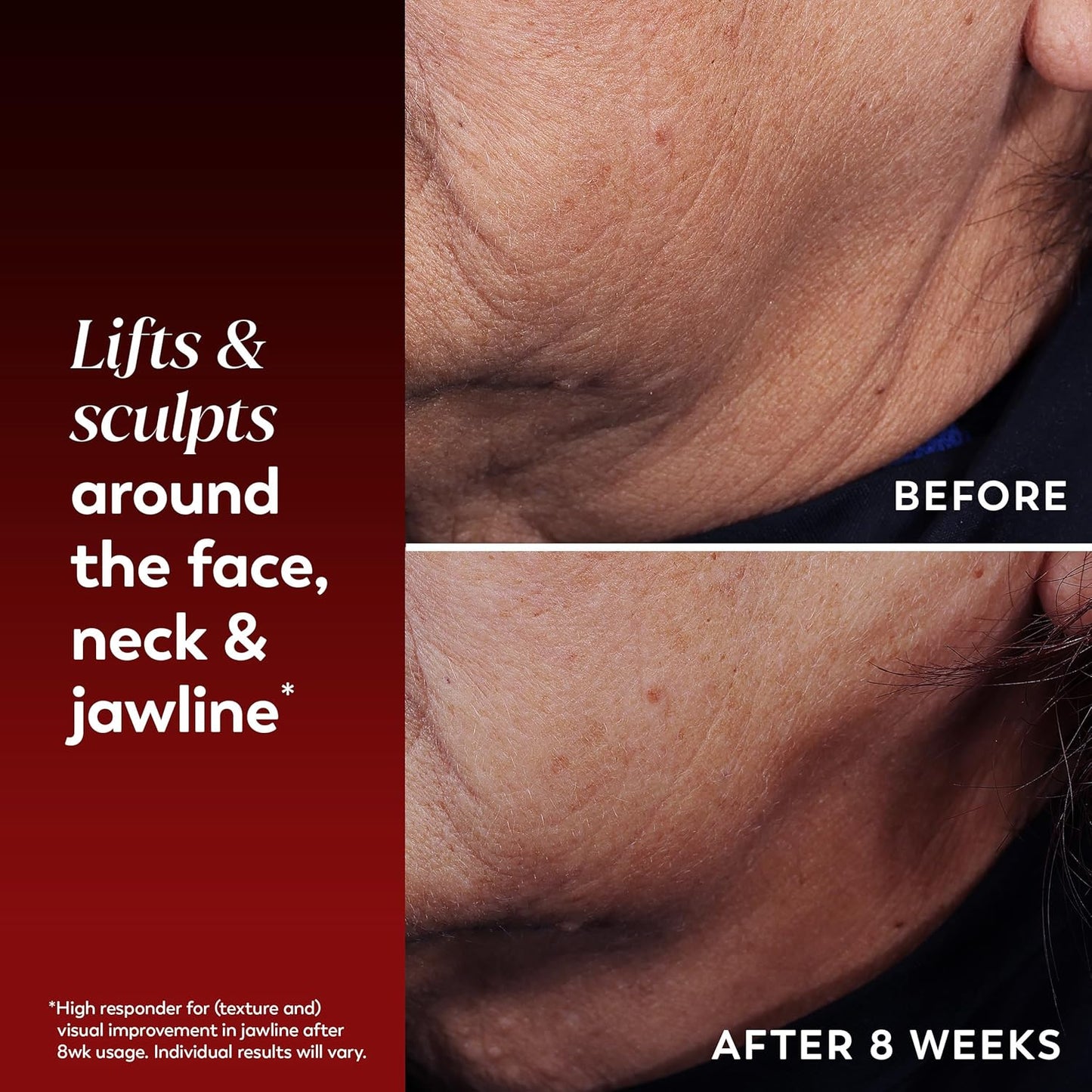 Regenerist Face & Neck Lifting Treatment